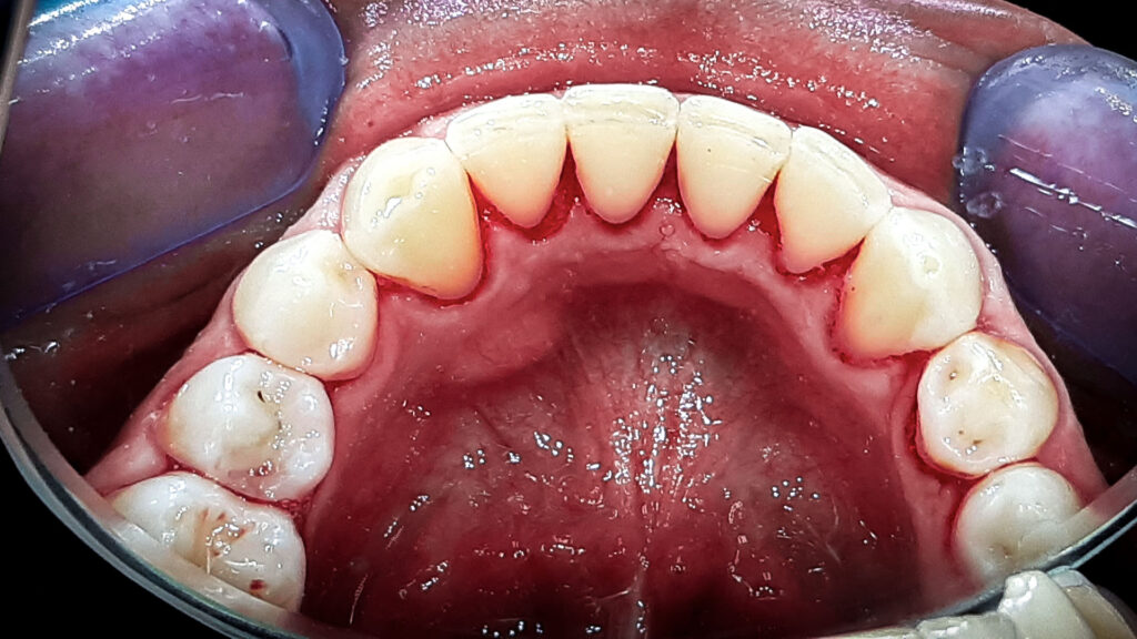 Kamenac na zubima - čišćenje i pjeskarenje u dental centru ostojić poslije