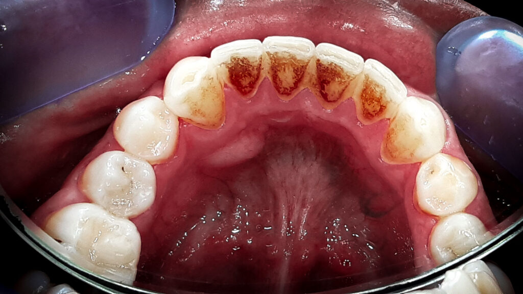 Kamenac na zubima - čišćenje i pjeskarenje u dental centru ostojić prije