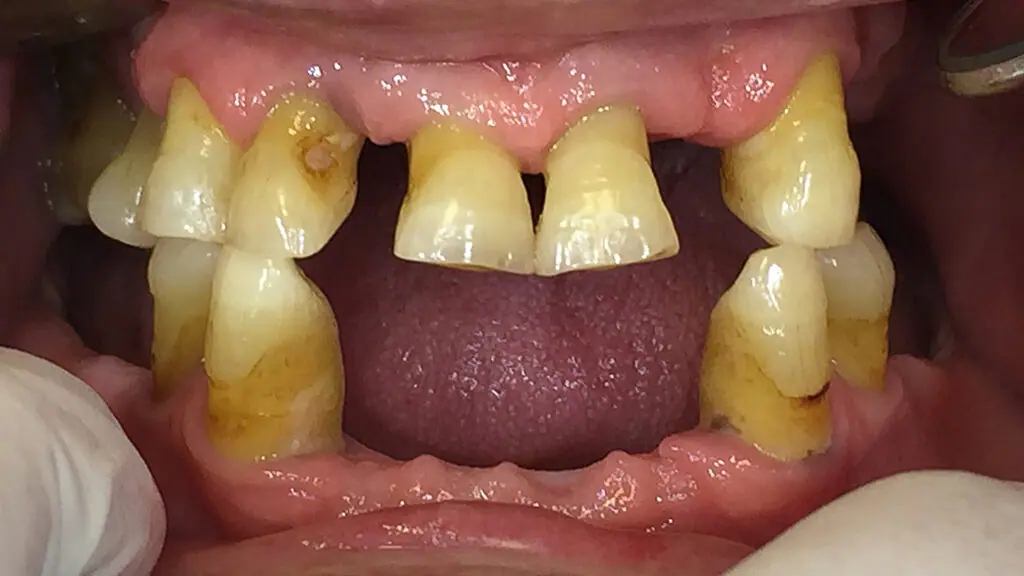Zubna proteza - prije