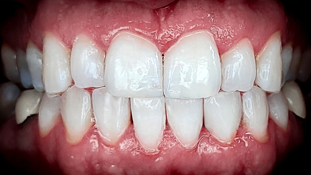 dentalna usluga u dental centru ostojić izbjeljivanje zubi poslije