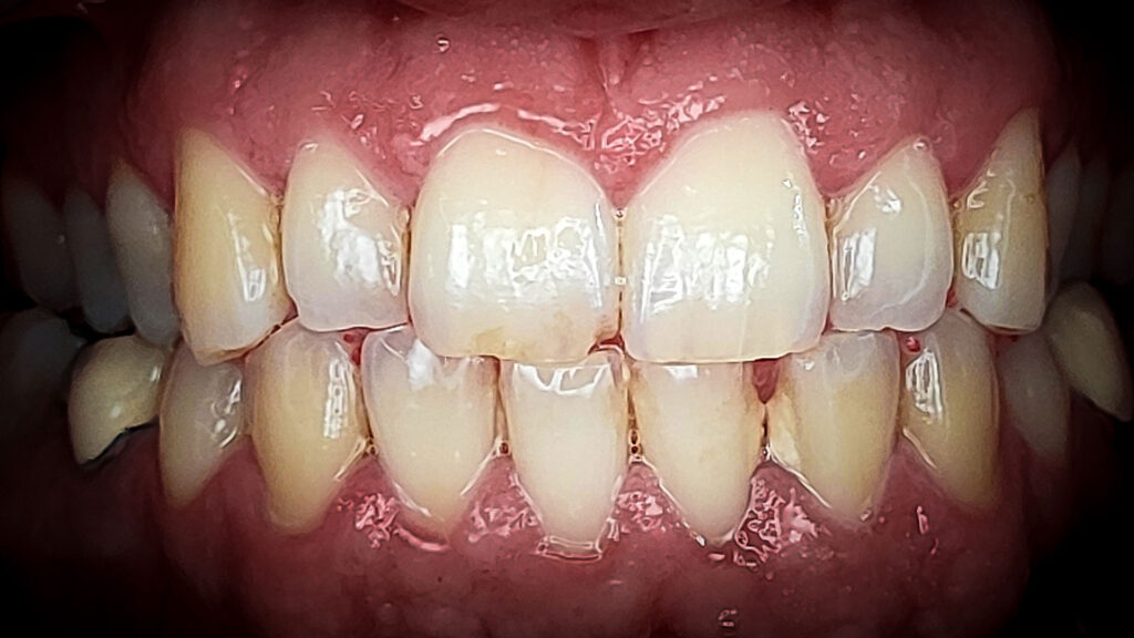 dentalna usluga u dental centru ostojić izbjeljivanje zubi prije
